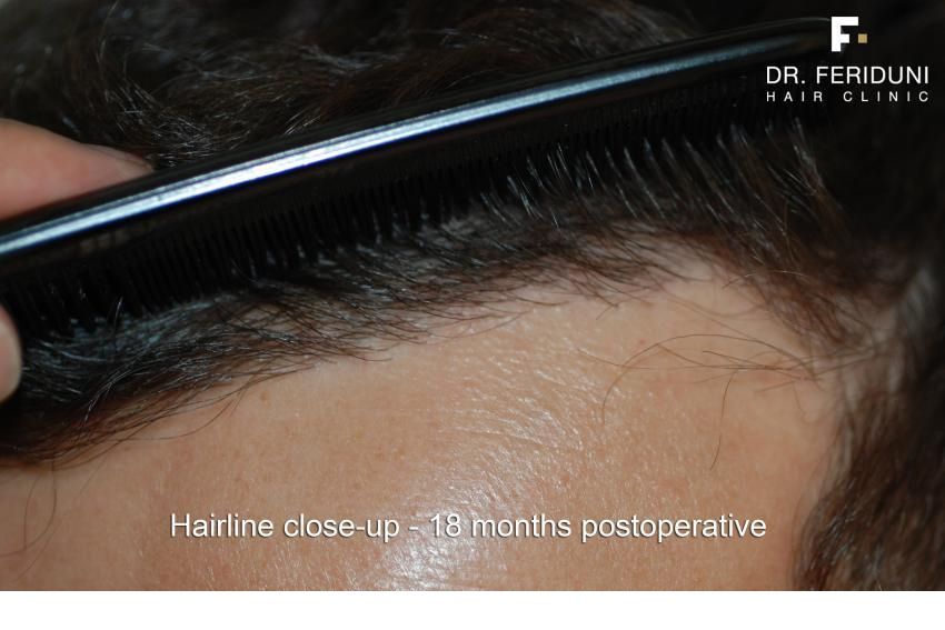 tn_Hairlineclose-uppostoperative1